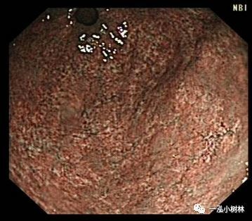 萎缩性胃炎胃镜图片图片