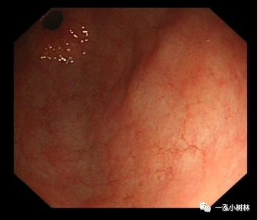 萎缩性胃炎图集