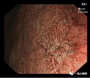 提示腸上皮化生刷狀緣.是內鏡診斷胃黏膜腸上皮化生的有效標誌.