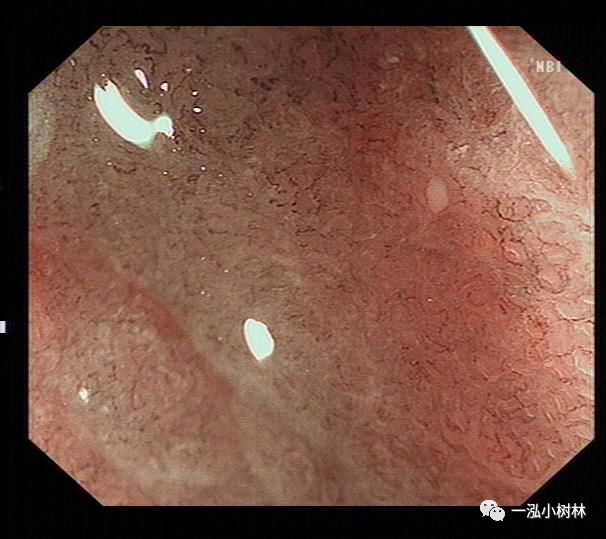 萎缩性胃炎图集