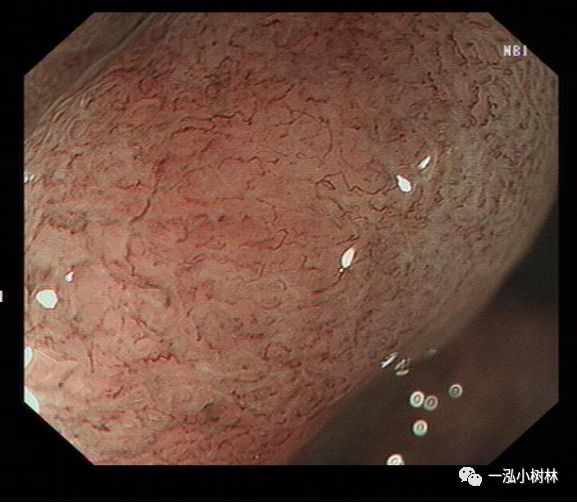 萎缩性胃炎图集