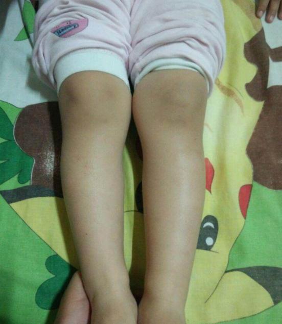 什么是孩子的夹腿综合征这几个时间段别让娃独处