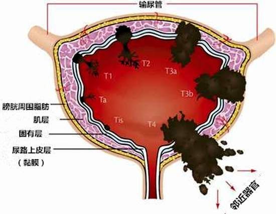 膀胱癌示意图图片