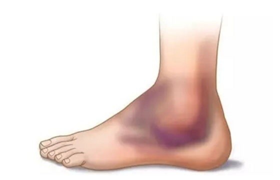 软组织损伤你还在热敷吗