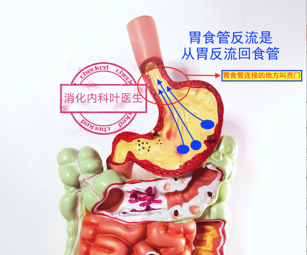 炎顧名思義通俗點理解其實就是胃裡面的胃酸反流回食管或者反流回口腔