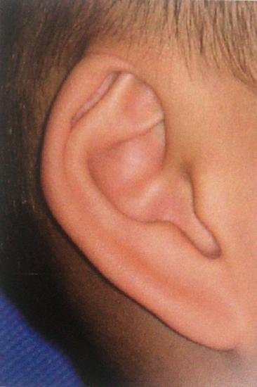轻度的隐耳仅仅耳廓上部的皮肤短缺,软骨的发育基本不受影响.