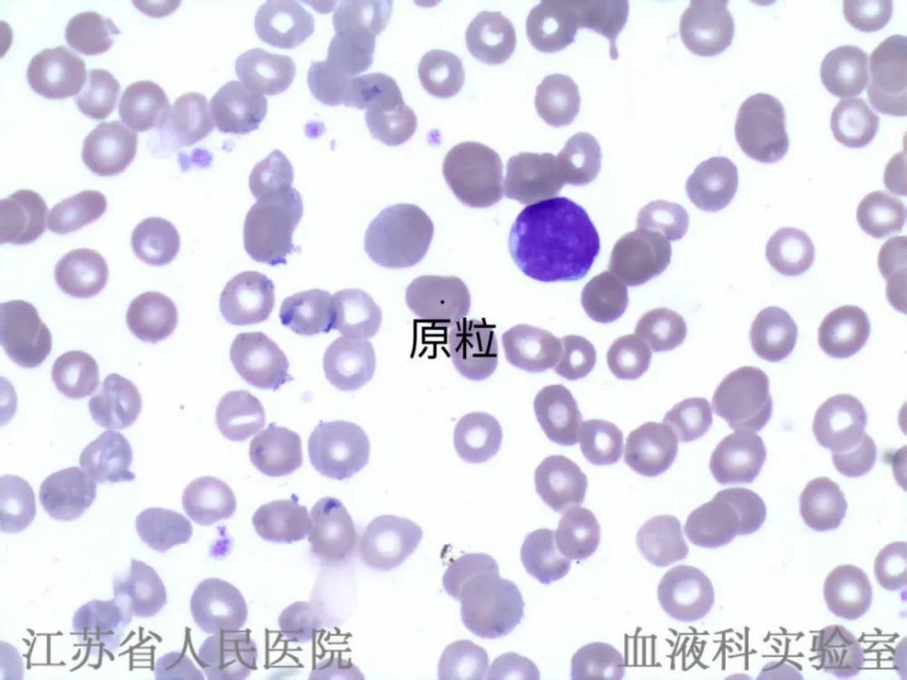 每周一期,学会发骨髓报告单