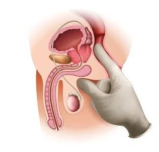 肛门指检到底是查什么的能查出直肠癌吗