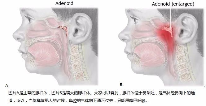 竟然34％的孩子有腺样体肥大，保守还是手术？_腾讯新闻