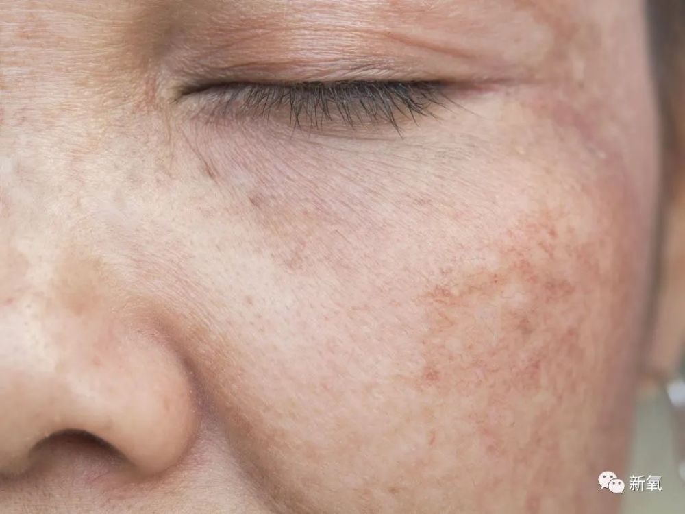 欧阳娜娜和宋祖儿都在脸上画雀斑一对比颜值高下立现