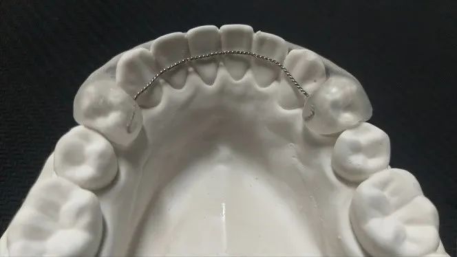 舌侧保持器那么,要怎么选择保持器呢?