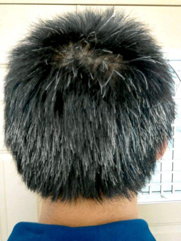 少白头和少秃顶的区别