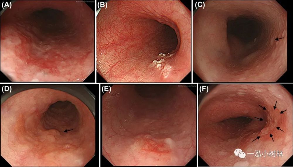 早期食管鳞状细胞癌浸润深度的放大内镜分类 腾讯新闻