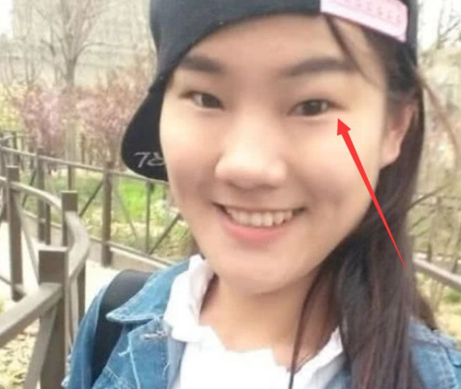 鱼泡眼也称为肿泡眼,柿子姐其实也是这样的眼型,脸上也并不是脂肪很多