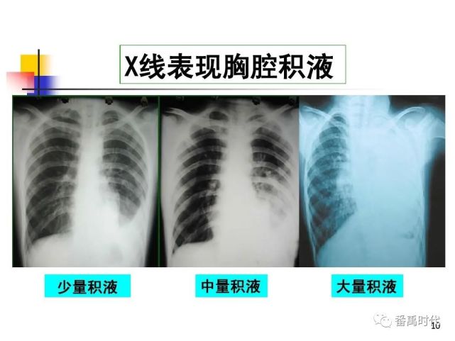 多見於充血性心力衰竭,縮窄性心包炎,肝硬化,上腔靜脈綜合徵,腎病