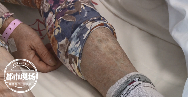 嘴唇发硬皮肤变黑,甚至改变容貌!季节高发皮肤病要注意