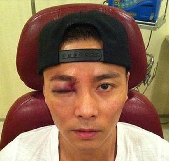 黄晓明自曝脚丫子打过6根钢钉受伤照不忍直视如今买鞋都不易