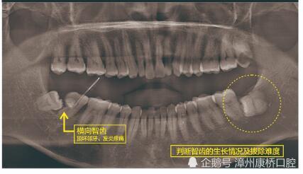 活了二十几年了 才知道智齿长歪了是真正的危害 腾讯新闻