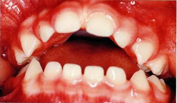 宝妈|吮指|母乳喂养|安抚奶嘴|牙齿