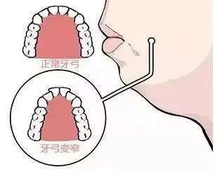 安抚奶嘴至牙齿变形图图片