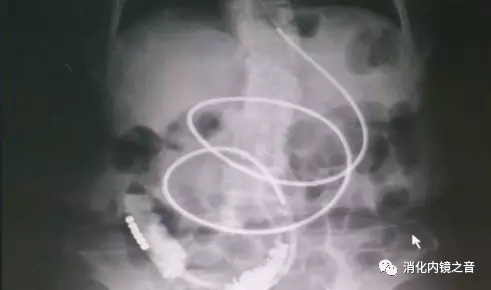 (2)肠梗阻导管的优势是足够长和有效减压(经鼻肠梗阻导管)肠梗阻导管