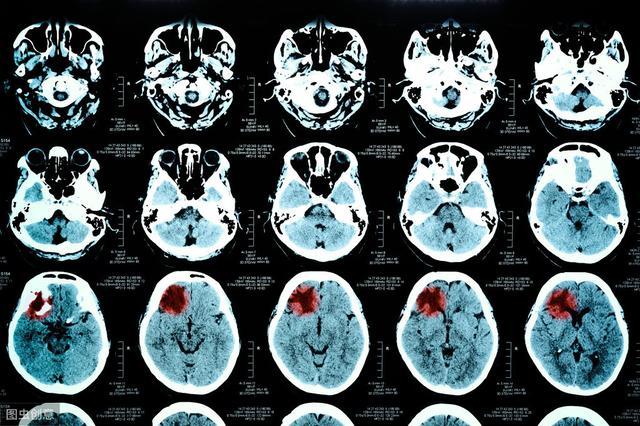 脑血管病来临前,会给你发"信号",早期不抢时间的人,代价惨痛