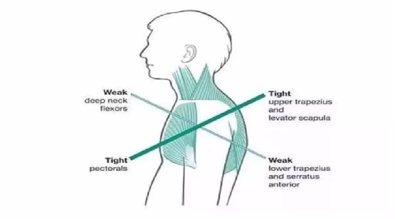 上交叉综合症的康复治疗