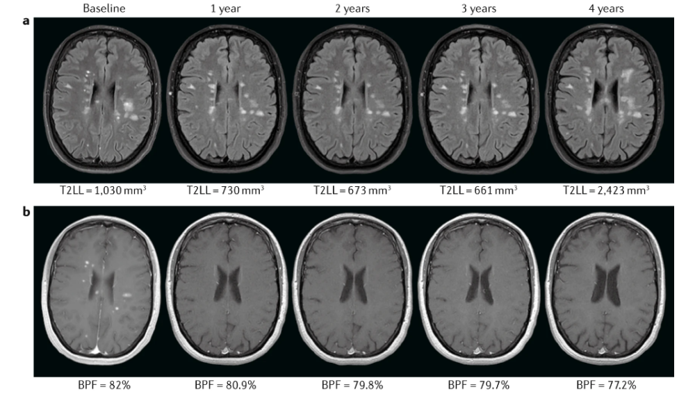 MAGNIMS共识建议：脑和脊髓萎缩在MS临床实践中的应用_腾讯新闻