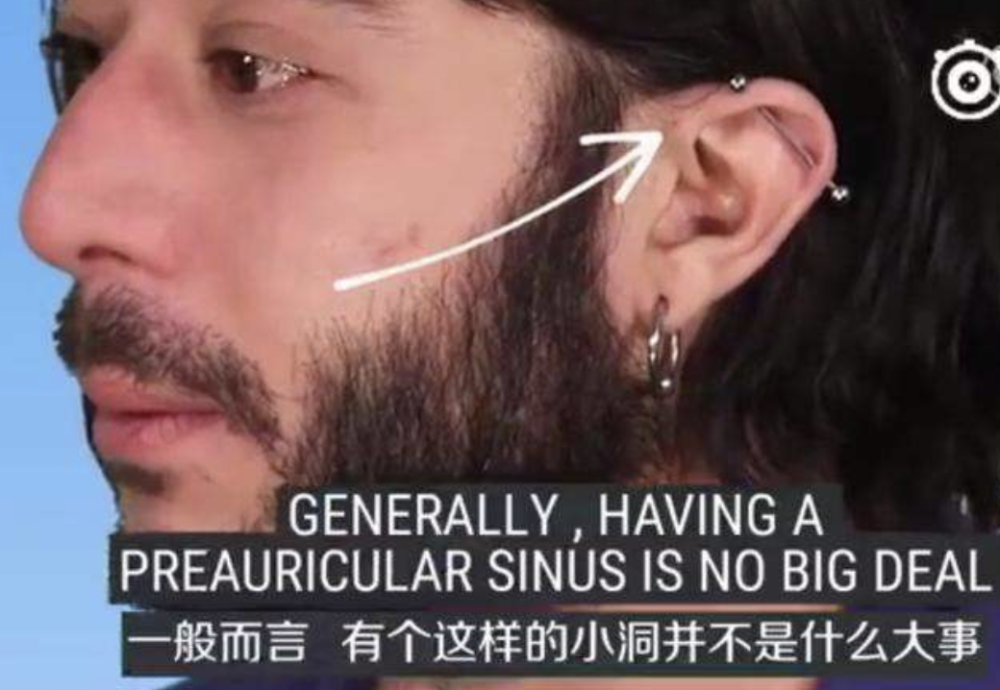 不到5%的人耳朵上有神秘小洞,里面藏着什么?