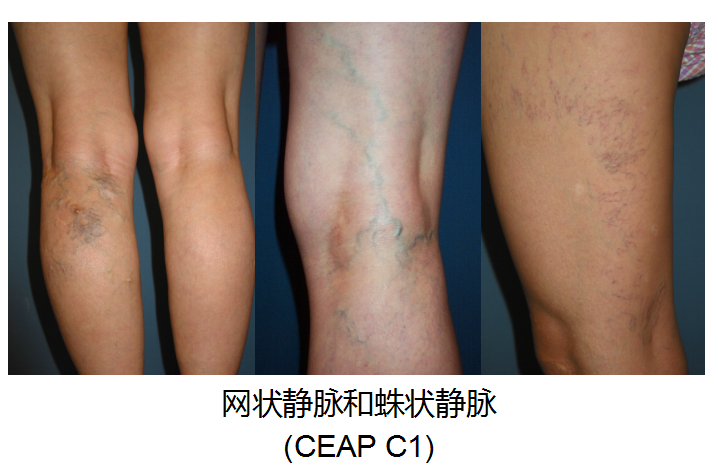 5天时间血管从小腿堵到大腿根你身上有没有这条蚯蚓
