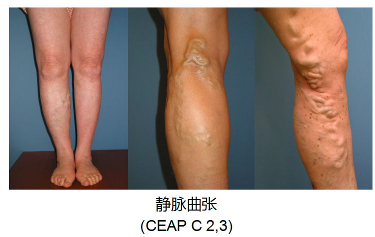 5天时间血管从小腿堵到大腿根你身上有没有这条蚯蚓