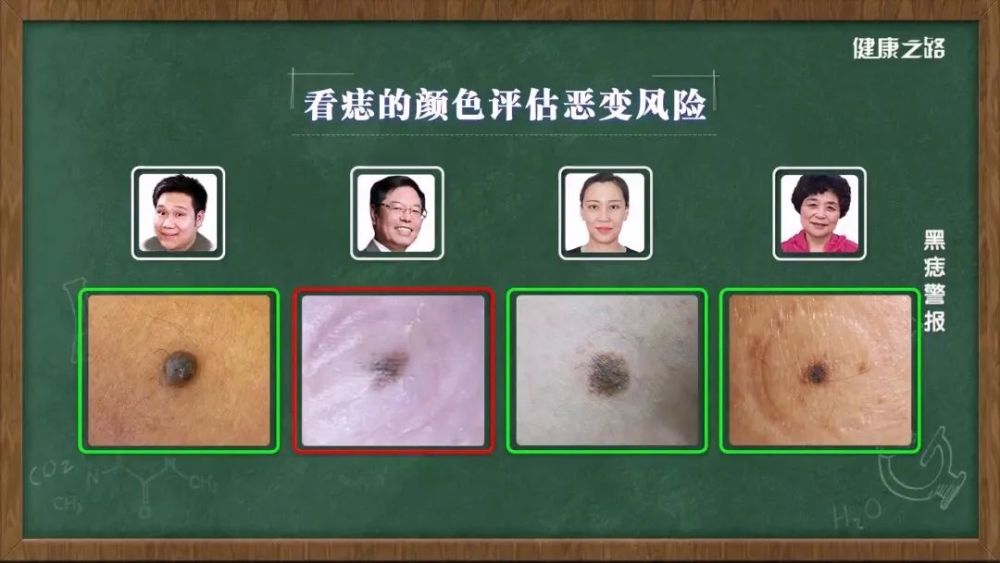 手心,脚后跟,脚趾,口腔黏膜,外生殖器处恶变风险较高,特别是交界痣