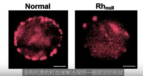 世上最罕见血型黄金血液全世界只有43人拥有极度珍贵