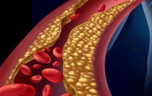 如何给血管垃圾进行大扫除4类食物清血管垃圾告别高血脂