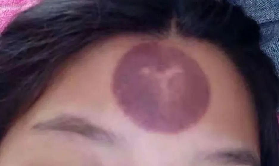 拔火罐是我这一生冒过最大的险