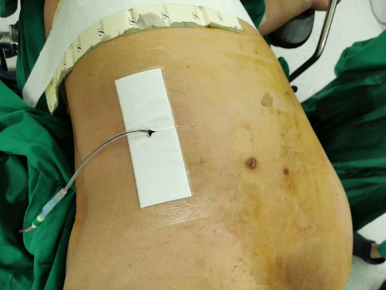 患者术后仅右侧腰部留置一根肾造瘘管值得一提的是,本次术中应用的输