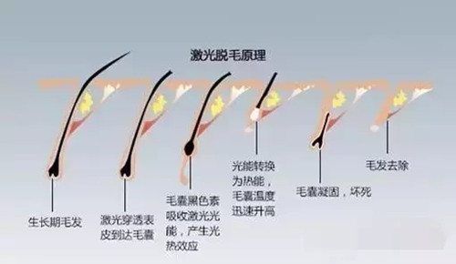 脱毛膏、剃须刀、激光脱毛，究竟哪种脱毛方法最有效？_腾讯新闻