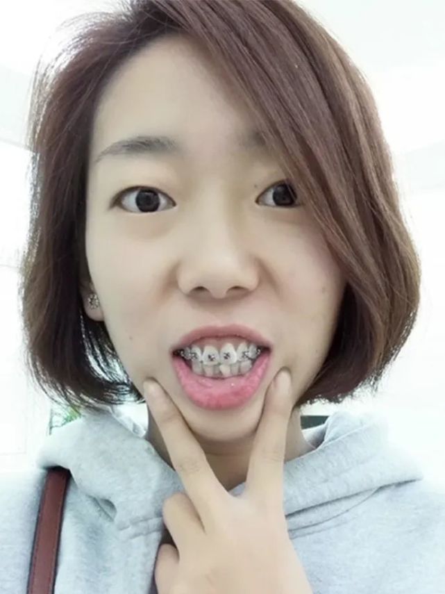短短18个月的时间,考虑了良久,小姜决定去做牙齿矫正.听说矫牙