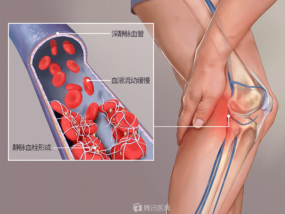 警惕这4点症状可能是深静脉血栓形成的信号千万别忽视严重影响健康