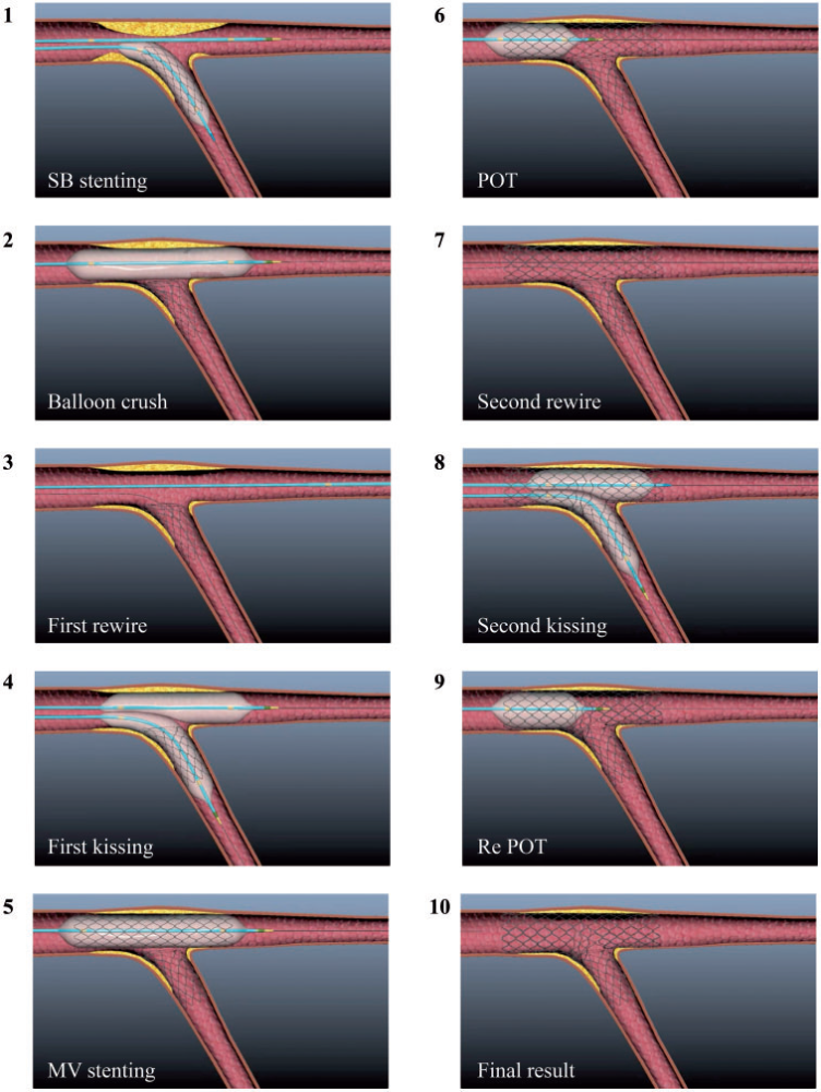 2015年,团队成功向法国europcr现场直播dk-crush演示.