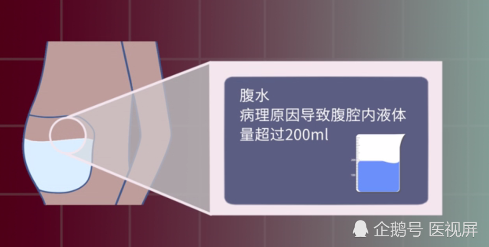 医生如何应对顽固性腹胀 先提防 先风后雨 再应战 腹水 难收 腾讯新闻