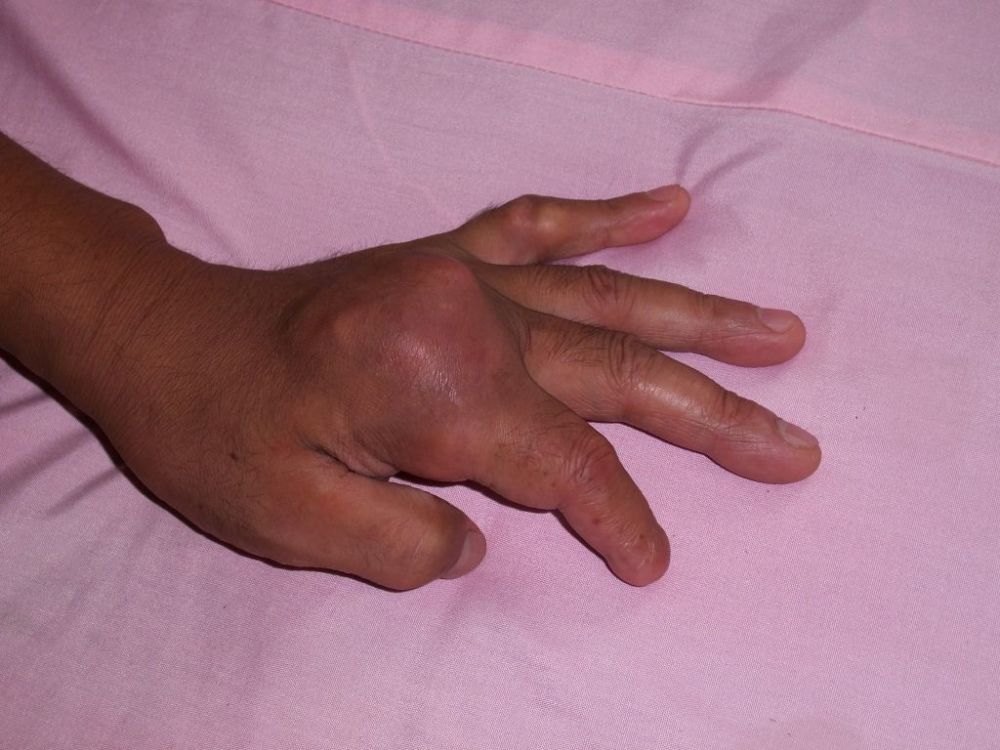 除了酒,这4种水也容易诱发痛风,劝你赶紧戒掉