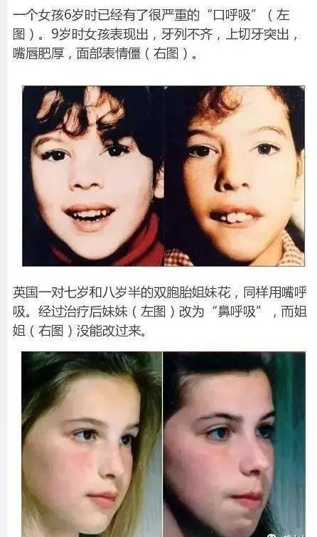 口呼吸的危害远不止以上,在我们口腔正畸医生看来,口呼吸最重要的是