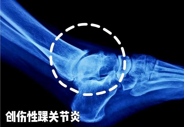 崴脚脖子只要能走就没大事儿医生辟谣韧带损伤请不要忽视