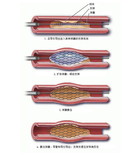 主要通过导管将支架送入冠状动脉中支撑其狭窄的部分,以达到恢复血流
