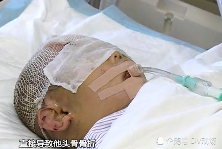 广东云浮5岁男童意外被打致脑死亡父母忍痛捐献器官