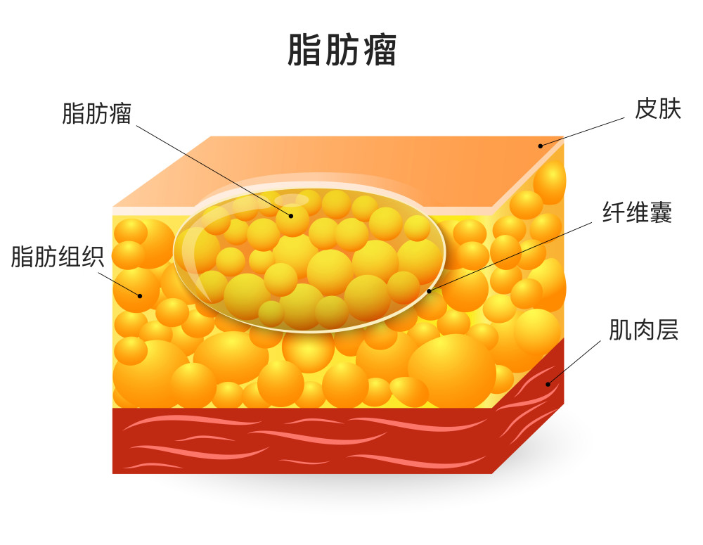 五,脂肪瘤到底要不要切?