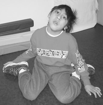 脑瘫时,肌肉会出现痉挛表现,可能会导致髋内旋肌群过度牵拉,使得孩子