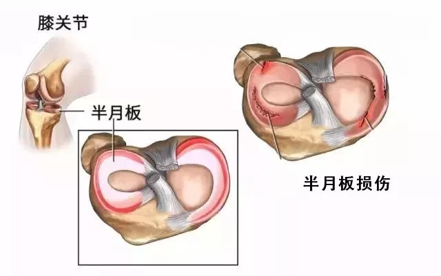 中老年人膝蓋疼痛還可能是半月板損傷