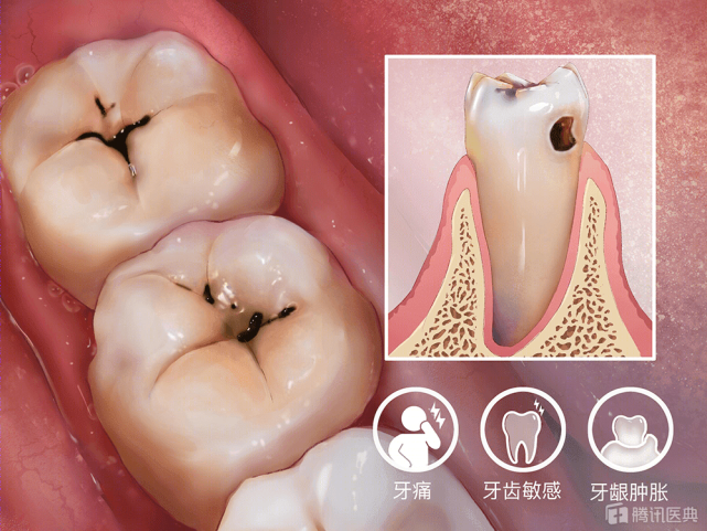 很多人都忽视了,教你4点预防|口腔|牙齿|天敌|龋齿|牙菌斑|根面龋